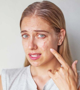 Empat Produk Skincare Ini Bisa Dipakai untuk Membersihkan Kulit Wajah Tipe Acne Prone
