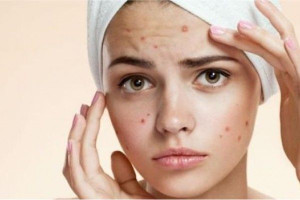 Phylobioma, Kandungan Skincare yang Efektif Atasi Jerawat