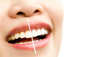 Cara Memutihkan Gigi Dengan Bahan Sederhana